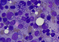 Hsitoplasmosis on bone marrow aspirate (Leishmann stain)