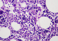 H&E-stained trephine biopsy,