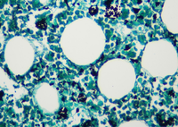 GMS Stain results on bone trephine section