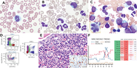 Myelodysplastic CMML-1 mimicking ITP, unmasked by corticosteroids: evolution from clonal monocytosis