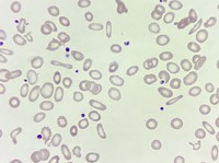 Elliptocytes/Pencil cells