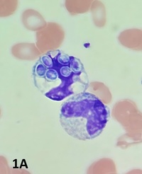 Peripheral blood smear showing monocyte with intracellular fungal organisms