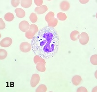 Peripheral blood smear showing neutrophil with intracellular fungal organisms