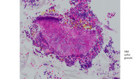 H&E Staining Sulfur granule