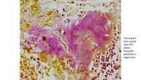 Tissue gram stain shows fuzzy/dot positivity in Actinomyces