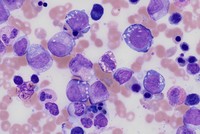 Myeloid and erythroid vacuolation in acquired copper deficiency secondary to zinc supplementation and jejunostomy feeds 1