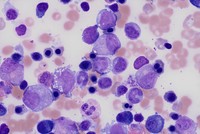 Myeloid and erythroid vacuolation in acquired copper deficiency secondary to zinc supplementation and jejunostomy feeds 2