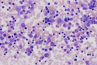 Myeloid and erythroid vacuolation in acquired copper deficiency secondary to zinc supplementation and jejunostomy feeds 3