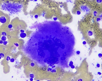 Staghorn Megakaryocyte On Bone Marrow Aspirate