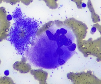 Staghorn Megakaryocyte On Bone Marrow Aspirate
