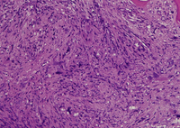 Morphology Of Megakaryocytes in Myelofibrosis