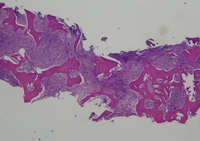 Bone trephine In Myelofibrosis