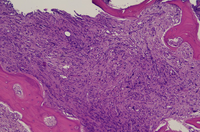 Bone trephine In Myelofibrosis