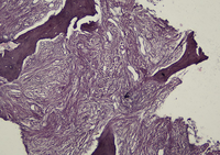 Reticulin Grading 3 In Myelofibrosis