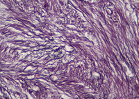 Reticulin Grading 3 In Myelofibrosis