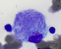 Morphology Of Storage cell In Gaucher Disease.