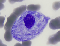 Morphology Of Storage cell In Gaucher Disease.