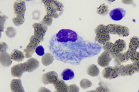 Morphology Of Storage cell In Gaucher Disease.