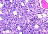 Bone marrow biopsy showing hypercellular marrow with erythroid predominance