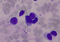 Ewing Sarcoma Cell on bone marrow aspirate