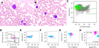 Transient aberrant plasma cells in a young patient with chronic inflammatory disease
