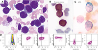 NPM1-mutated acute myeloid leukemia with a hybrid granulocytic and monocytic phenotype