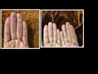 Acrocynosis with Hemolytic Anaemia