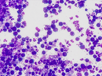 Diffuse Large B cell Lymphoma Ascitic fluid Smear