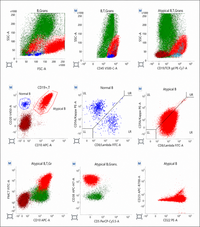 Diffuse Large B cell Lymphoma Flow cytometry