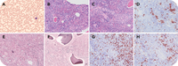 Dissecting the genetic threads underlying the fabric of pediatric myelofibrosis