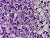 ALCL cells in the bone marrow