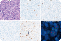 Classic Hodgkin lymphoma with IGH::CCND1 rearrangement: evidence of clonal relation to preceding mantle cell lymphoma