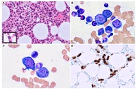 Diagnostic Challenge: Parvovirus B19 Infection Mimicking Bone Marrow Failure in a Transplant Recipient