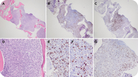 Next-generation IHC: identifying TP53 mutation origin in a bone marrow with concurrent CLL and AML