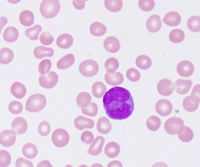 Abnormal Promyelocyte 1