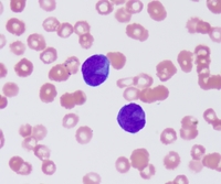 Abnormal Promyelocyte 2