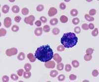Abnormal Promyelocyte MPO stain