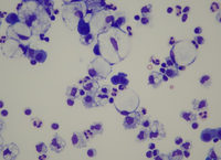 Signet Ring cells in metastatic ovarian carcinoma. 1