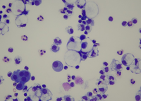 Signet Ring cells in metastatic ovarian carcinoma. 2