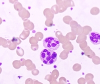 Hypersegmented Neutrophils