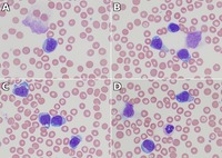 Numerous large lymphoid cells in peripheral blood mimicking blasts in a case of Richter transformation of CLL