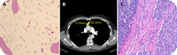 Thymoma-associated aplastic anemia with concurrent Good syndrome