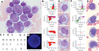 Morphologic and flow cytometric features of menin inhibitor–induced pseudoprogression in KMT2A-rearranged acute myeloid leukemia