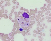 Bone Marrow Histiocyte Laden with Intracellular Leishman-Donovan Bodies in Visceral Leishmaniasis