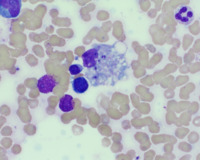 Parasitized Bone Marrow Macrophage Containing Leishman-Donovan Bodies