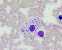 Abundant Leishman-Donovan Bodies in a Bone Marrow Aspirate Smear