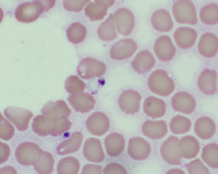 Numerous Extracellular Leishman-Donovan Bodies in Bone Marrow Aspirate