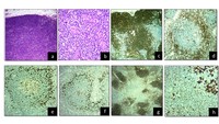 Nodal T Follicular Helper cell lymphoma, angioimmunoblastic type 1