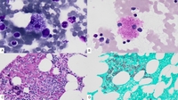Ghost Histoplasma: Residual Intracellular Yeasts Following Therapy