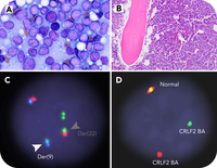 Acquisition of Philadelphia chromosome at relapse in a case of Ph-like B-ALL